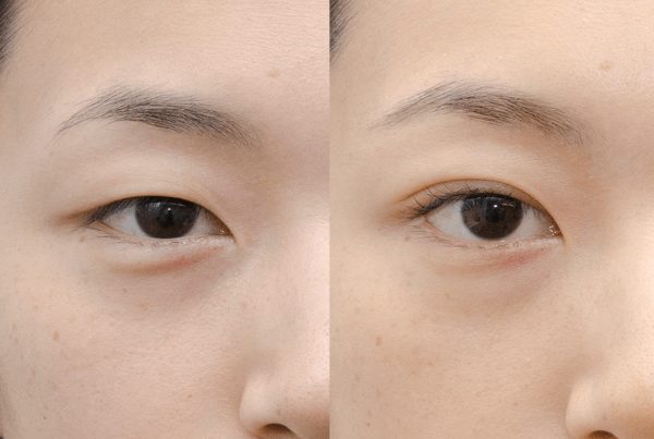 Upper and Lower Eyelid Surgery